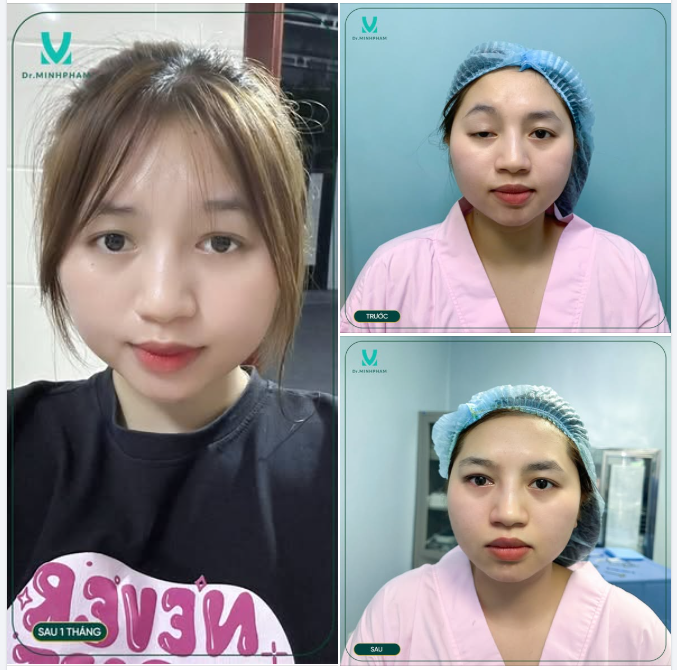 FEEDBACK SAU 1 THÁNG TREO MI VẠT CƠ TRÁN