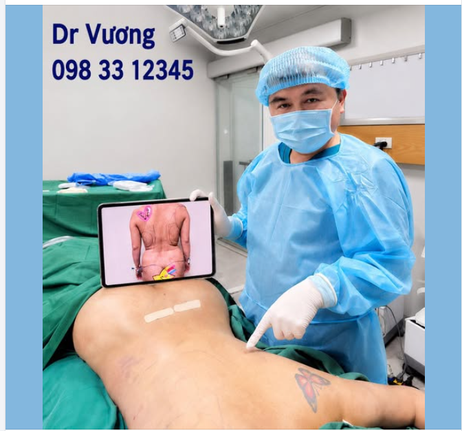 hút mỡ lưng ko sẹo không phải nặn dịch