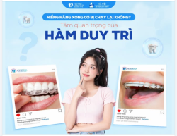 NIỀNG RĂNG XONG CÓ CẦN THIẾT PHẢI ĐEO HÀM DUY TRÌ KHÔNG?