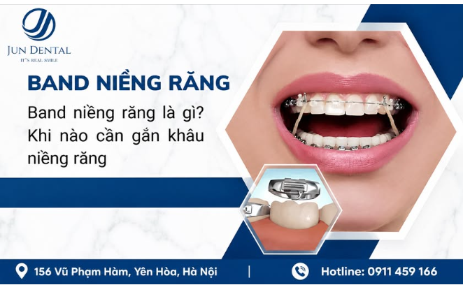 BAND CHỈNH NHA LÀ GÌ? KHI NÀO CẦN GẮN BAND?