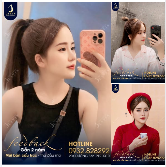 TỪNG LO LẮNG KHI QUYẾT ĐỊNH NÂNG MŨI GIỜ RA SAO?