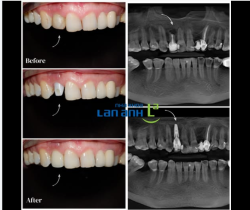 Phục hình răng cửa trên Implant – Khi kỹ thuật & thẩm mỹ phải đạt đến độ tinh tế cao nhất