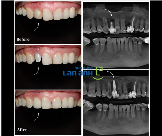 Phục hình răng cửa trên Implant – Khi kỹ thuật & thẩm mỹ phải đạt đến độ tinh tế cao nhất