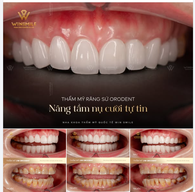 Một nữ khách hàng đã có hành trình “nâng tầm nụ cười” vẹn tròn hạnh phúc như vậy cùng với Win Smile.