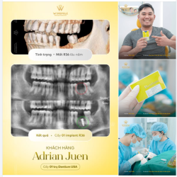 VỀ VIỆT NAM TRỒNG IMPLANT, KHÁCH HÀNG ÚC NHẬN KẾT QUẢ ĐIỀU TRỊ VƯỢT MONG ĐỢI