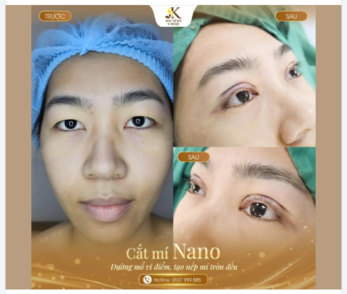 Cắt mí Nano - Đường mổ vi điểm, tạo nếp mí tròn