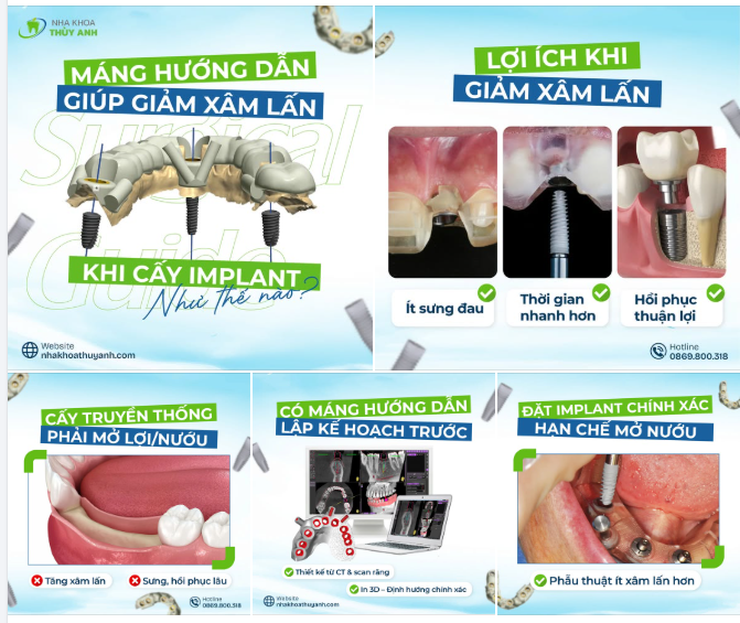 MÁNG HƯỚNG DẪN PHẪU THUẬT IMPLANT: GIẢI PHÁP GIÚP CẤY GHÉP CHÍNH XÁC VÀ ÍT XÂM LẤN