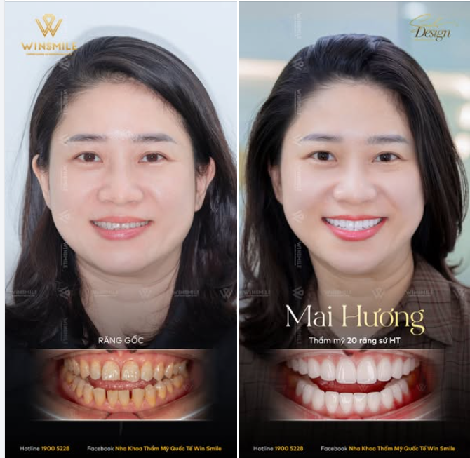Mang một khuôn mặt trái xoan phúc hậu cùng những nét rất duyên, nhưng khuyết điểm từ nụ cười lại khiến chị Mai Hương ngần ngại trao đi sự tự tin và thần thái rạng rỡ suốt nhiều năm trời