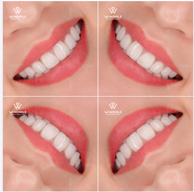 KHI THẨM MỸ VENEER CHẠM ĐẾN SỰ HOÀN HẢO CỦA NỤ CƯỜI TỰ NHIÊN