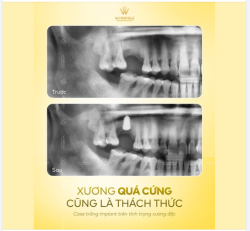 ĐÔI KHI, XƯƠNG QUÁ CỨNG CŨNG LÀ MỘT THÁCH THỨC