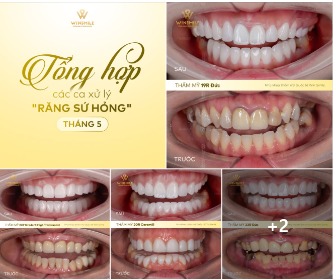 THÁNG 5 TẠI WIN SMILE: TẠM BIỆT SỨ HỎNG, “KHOÁC ÁO MỚI” CHO NỤ CƯỜI TỰ TIN