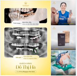 THAY THẾ CẦU SỨ BẰNG IMPLANT: GIẢI PHÁP ĂN NHAI CHẮC CHẮN VÀ ỔN ĐỊNH LÂU DÀI HƠN