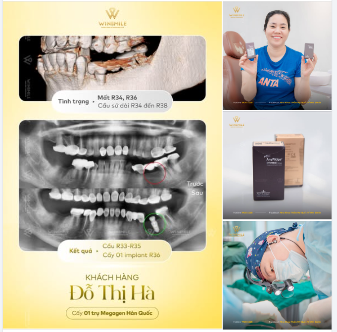 THAY THẾ CẦU SỨ BẰNG IMPLANT: GIẢI PHÁP ĂN NHAI CHẮC CHẮN VÀ ỔN ĐỊNH LÂU DÀI HƠN