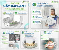QUY TRÌNH CẤY GHÉP IMPLANT VỚI MÁNG HƯỚNG DẪN PHẪU THUẬT