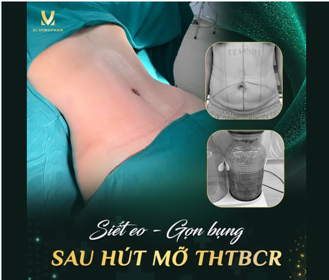 EO GỌN – DÁNG XINH CHỈ SAU MỘT LẦN THỰC HIỆN