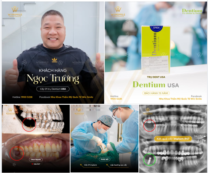 ĐIỀU TRỊ MẤT RĂNG SỚM: BƯỚC QUAN TRỌNG ĐỂ GIỮ HÀM RĂNG KHỎE MẠNH LÂU DÀI