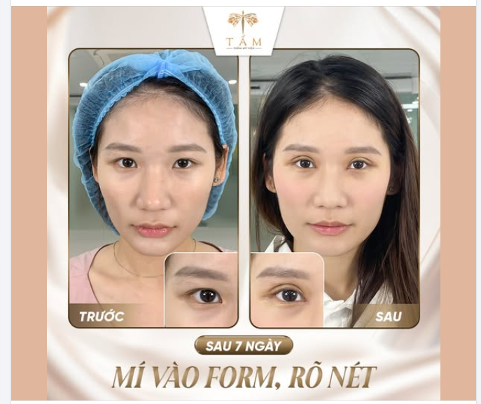 SỞ HỮU NẾP MÍ TRÒN ĐỀU, SẮC NÉT CHỈ SAU 7 NGÀY