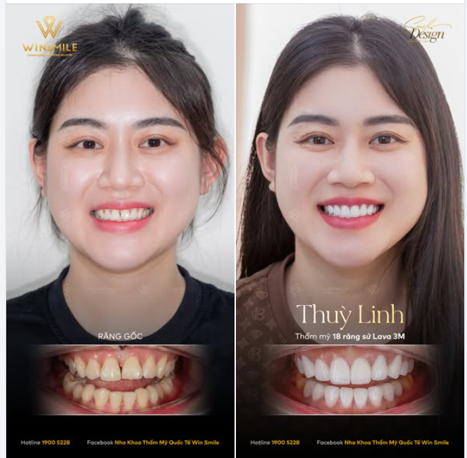 Sống nhiều năm tại Hàn Quốc - nơi mà quy chuẩn về ngoại hình luôn khắt khe đến ngột ngạt, Thùy Linh mang theo một áp lực vô hình khi trở về Việt Nsm.
