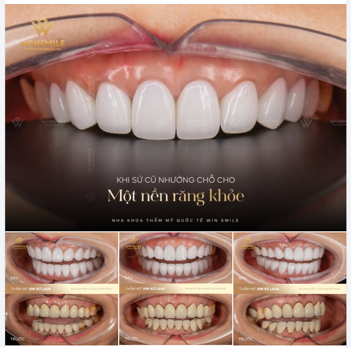 KHI SỨ CŨ NHƯỜNG CHỖ CHO MỘT NỀN RĂNG KHỎE MẠNH