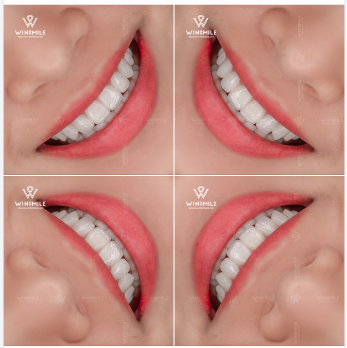 Một nụ cười đẹp là khi từng đường nét chạm đến sự hài hòa vừa đủ