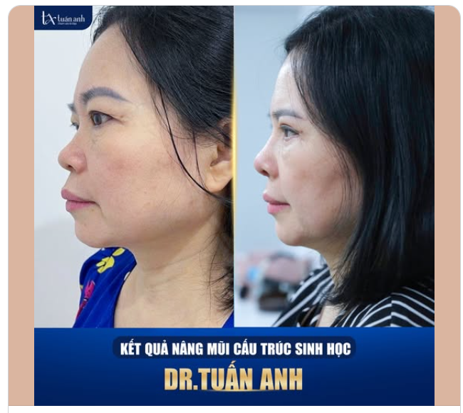 KẾT QUẢ NÂNG MŨI CẤU TRÚC SINH HỌC SAU 01 THÁNG