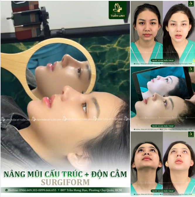 COMBO NÂNG MŨI + ĐỘN CẰM – HOÀN THIỆN GÓC NGHIÊNG CHUẨN ĐẸP!!