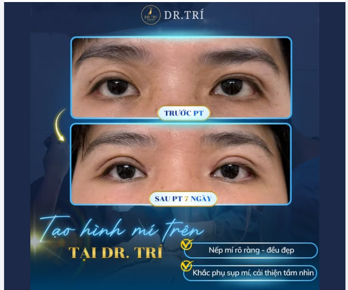 7 NGÀY CHO MỘT ĐÔI MẮT ĐẸP TOÀN DIỆN!