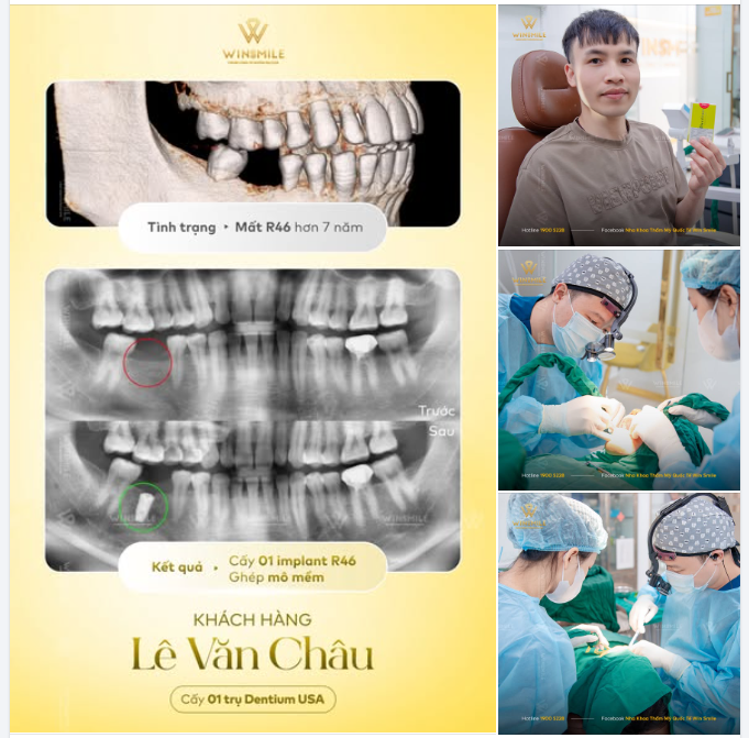 MẤT RĂNG 6 LÂU NĂM - KHÔI PHỤC ĂN NHAI CHẮC KHỎE VỚI IMPLANT