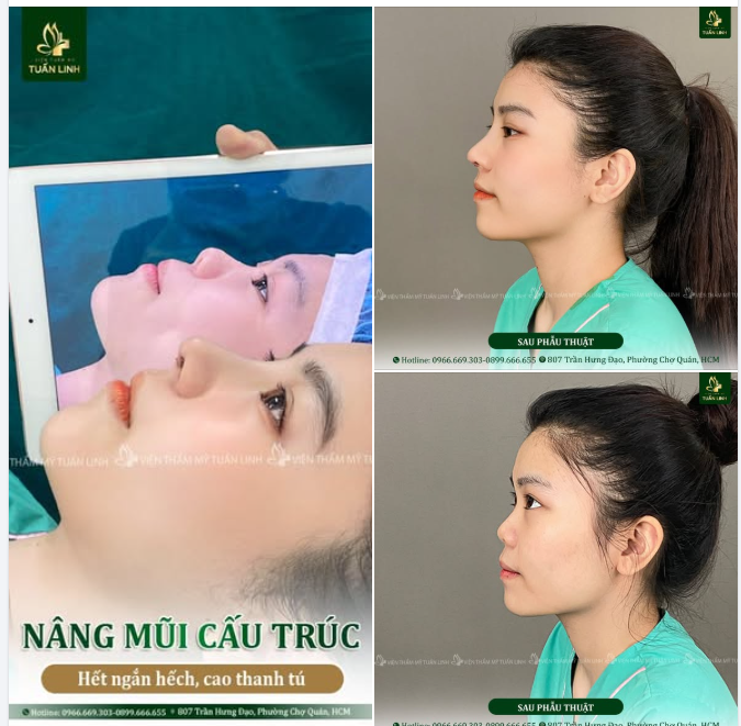 NÂNG MŨI CẤU TRÚC – HẾT NGẮN HẾCH, CAO THANH TÚ