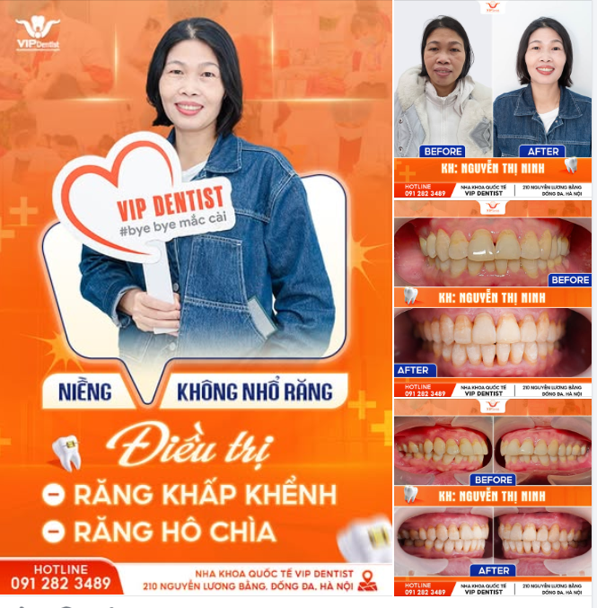 NIỀNG RĂNG U40 – KHÔNG NHỔ RĂNG – KHẮC PHỤC HÔ & KHẬP KHỂNH