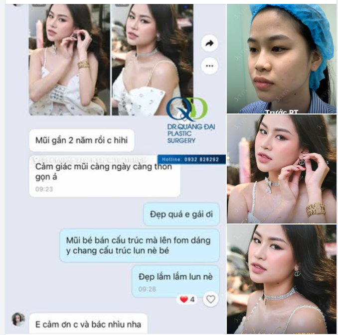 FEEDBACK GẦN 2 NĂM NÂNG MŨI BÁN CẤU TRÚC — THON GỌN TỪNG NGÀY, ĐẸP ĐÚNG NHƯ Ý