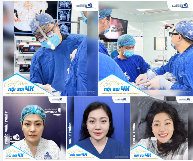 XÓA BỎ KHUNG XƯƠNG BẠNH ĐỔI LẤY DIỆN MẠO THANH THOÁT TRẺ TRUNG