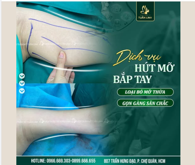 HÚT MỠ BẮP TAY – THON GỌN TỨC THÌ, TỰ TIN DIỆN ĐỒ