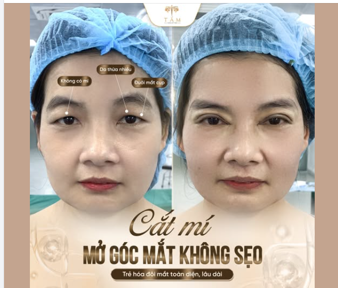 KHÔNG CÒN MẮT MỘT MÍ – TRẺ HÓA ĐÔI MẮT TỰ NHIÊN CHỈ SAU 1 LẦN CẮT MÍ