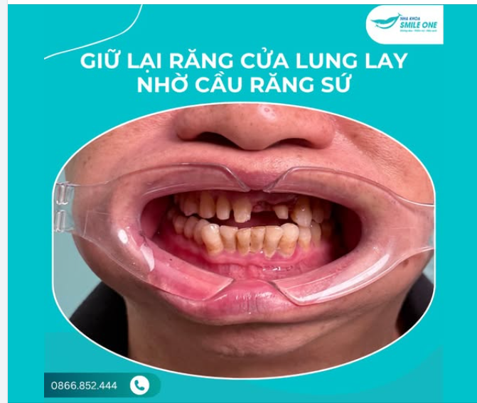 GIỮ LẠI RĂNG CỬA LUNG LAY SAU TAI NẠN NHỜ CẦU RĂNG SỨ