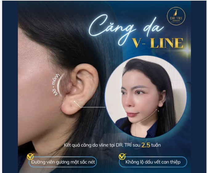 TỰ TIN MỌI GÓC NHÌN VỚI KĨ THUẬT CĂNG DA V-LINE TẠI DR. TRÍ