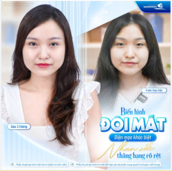 BIẾN HÌNH ĐÔI MẮT, DIỆN MẠO KHÁC BIỆT