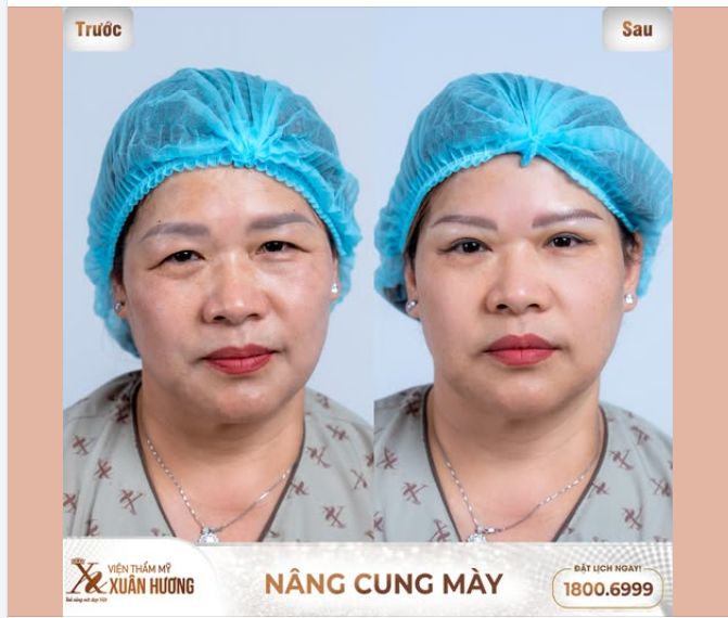 Chị khách Việt kiều Úc về Việt Nam liền ghé Xuân Hương để nâng cung mày, lấy lại đôi mắt và gương mặt trẻ trung vốn có