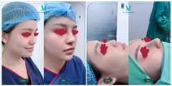 Dáng mũi thấp trước đó đã được TS.BS Minh Phạm điều chỉnh, mang đến diện mạo thanh thoát và hài hòa hơn với tổng thể gương mặt.
