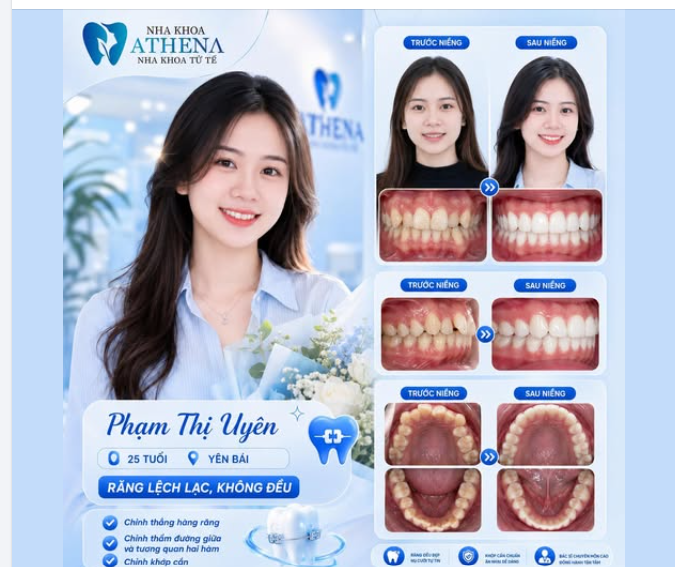 TẠM BIỆT RĂNG KHẤP KHỂNH, ĐÓN NỤ CƯỜI THẲNG TẮP CHỈ NHỜ NIỀNG RĂNG