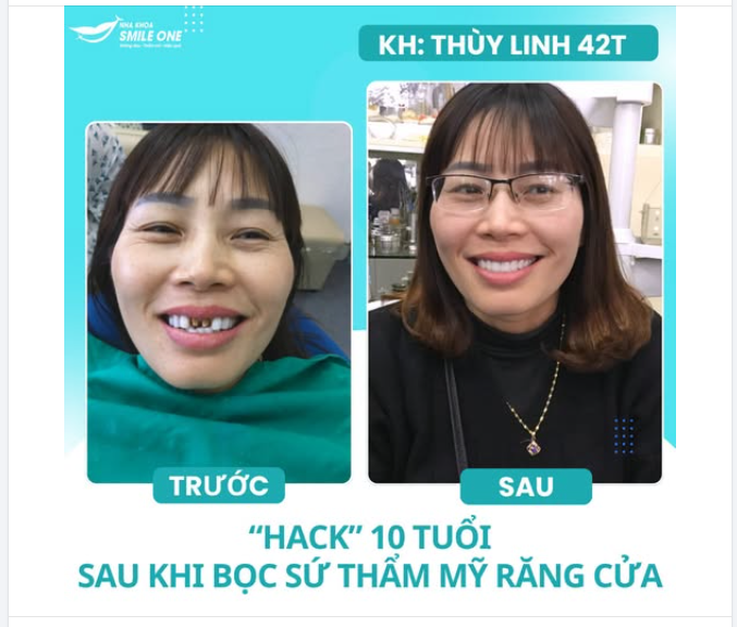 KHÁCH HÀNG THÙY LINH 42 TUỔI – LÀM RĂNG SỨ "HACK" 10 TUỔI