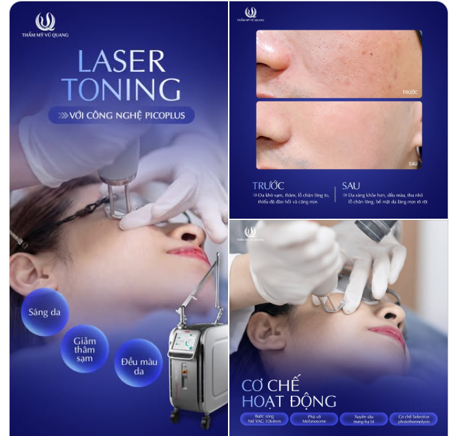 LASER TONING: DA TRẮNG ĐỀU MÀU, ĐẸP NGAY LẦN ĐẦU TIÊN!