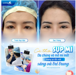 KHẮC PHỤC SỤP MÍ, DA CHÙNG & MỠ MÍ MẮT