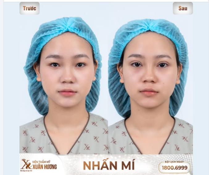 NHẤN MÍ CHỈ TỪ 4.5 TRIỆU