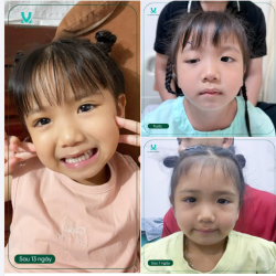 PHẪU THUẬT SỤP MÍ BẰNG PHƯƠNG PHÁP VẠT CƠ TRÁN