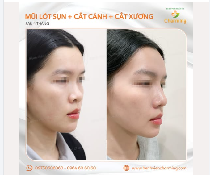 NHAN SẮC GÂY THƯƠNG NHỚ SAU NÂNG MŨI TẠI CHARMING