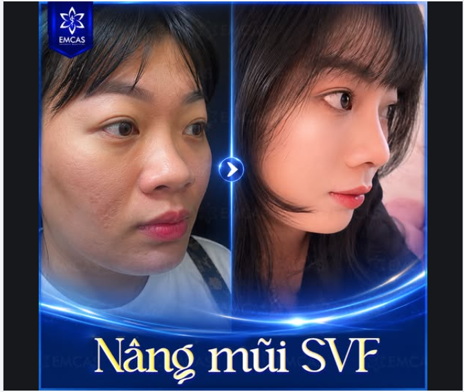 Minh chứng cho câu “Mũi cao quyết định 90% nhan sắc của nàng”