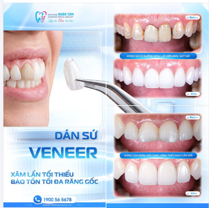 VENEER – KHI VẺ ĐẸP ĐẾN TỪ SỰ TINH TẾ VÀ BẢO TỒN