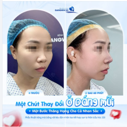 MỘT CHÚT THAY ĐỔI Ở DÁNG MŨI