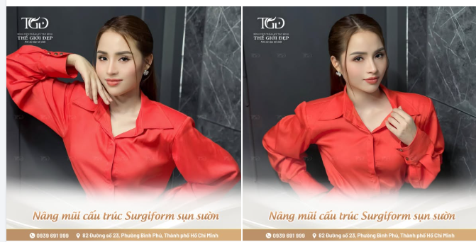Cùng Thế Giới Đẹp nhìn lại dung nhan rạng rỡ của Hoa hậu Nhân Ái Mai Thanh Nhàn sau 6 năm nâng mũi cấu trúc surgiform sụn sườn